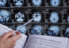 Scary Link Emerges: Memory Decline Person analyzing brain MRI images with a pen.